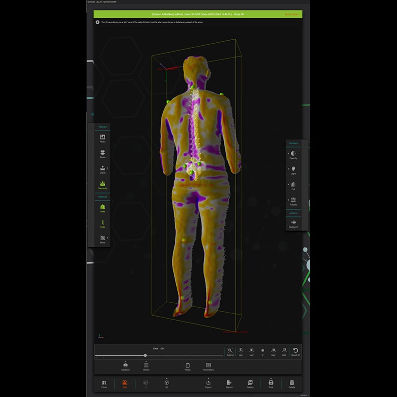 Система трёхмерного сканирования позвоночника Spine3D